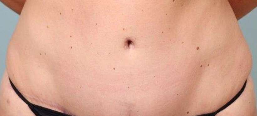 Tummy Tuck After-1