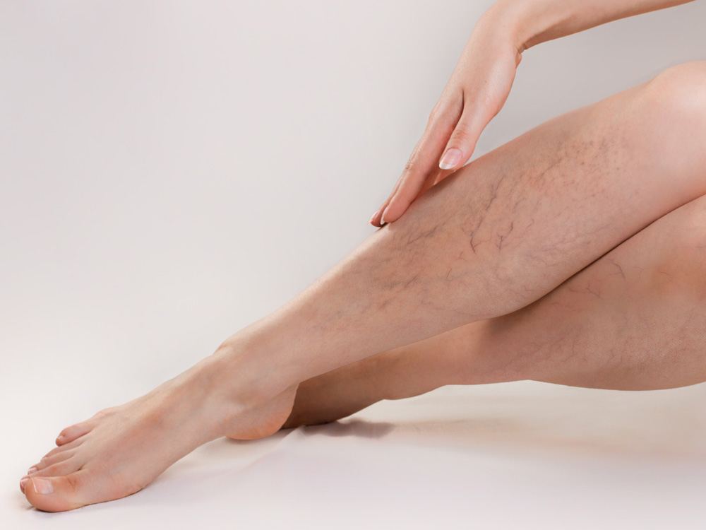 Sclerotherapy - Gateway Cosmetics
